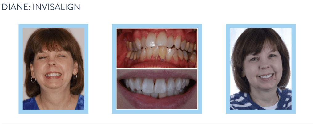 smile gallery - Invisalign