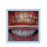 galería de sonrisas - Invisalign 