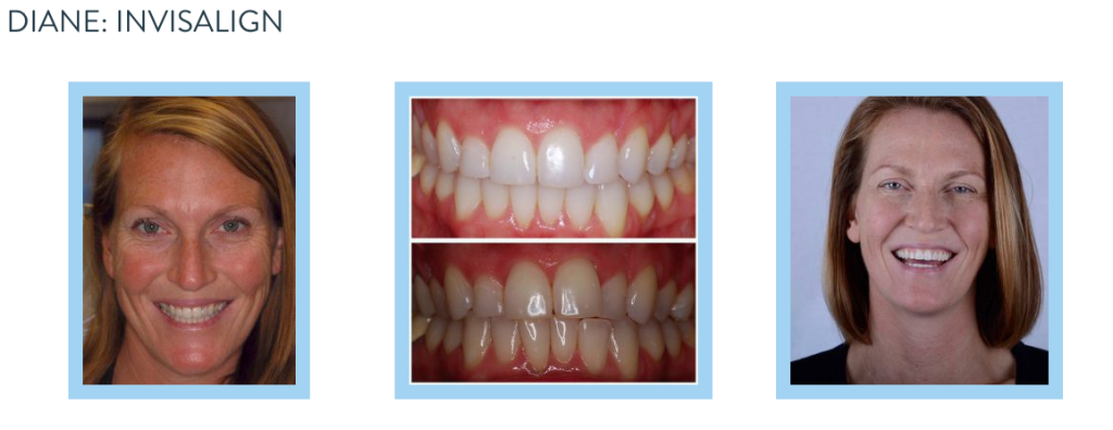 smile gallery - Invisalign