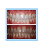 galería de sonrisas - Invisalign 