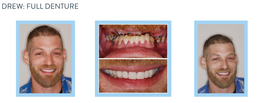 smile gallery - full denture