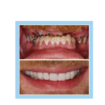 galería de sonrisas - full denture
