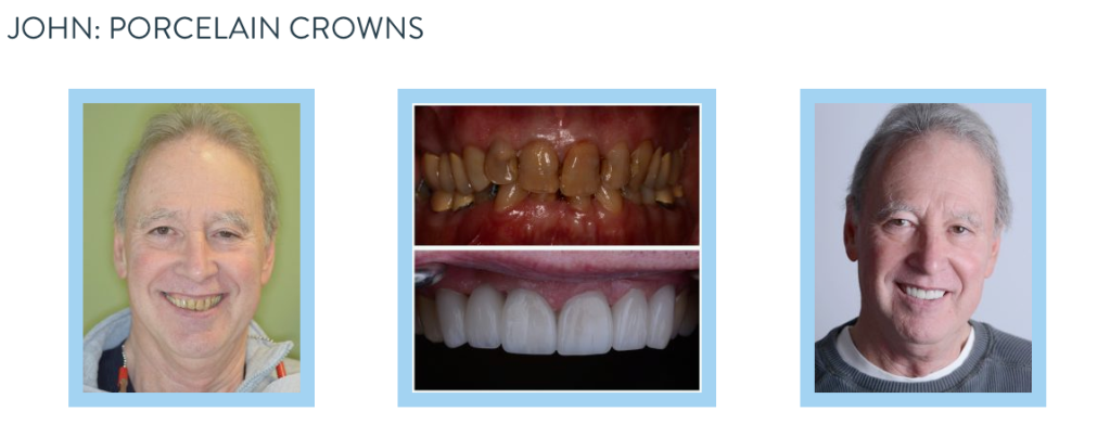 smile gallery - porcelain crowns