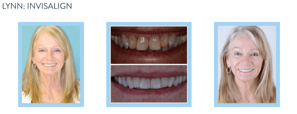 smile gallery - Invisalign