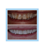 galería de sonrisas - Invisalign 
