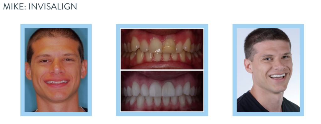smile gallery - Invisalign