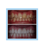 galería de sonrisas - Invisalign 