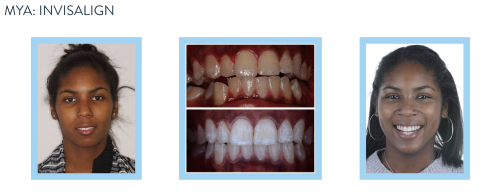 smile gallery - Invisalign