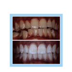 galería de sonrisas - Invisalign 
