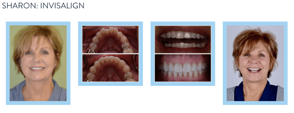 smile gallery - Invisalign 