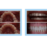 galería de sonrisas - Invisalign 