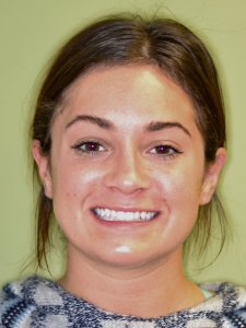 Woman before porcelain veneers