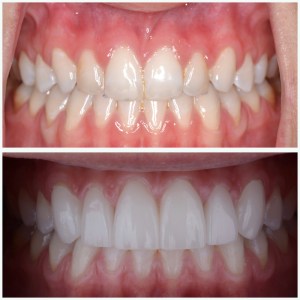 before and after porcelain veneers