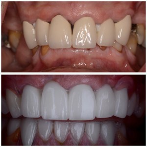 before and after porcelain crowns