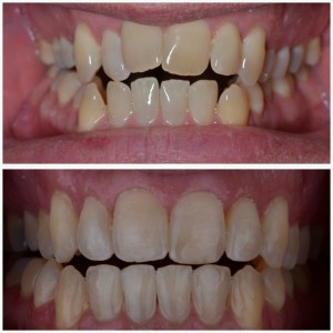 before and after Invisalign & whitening