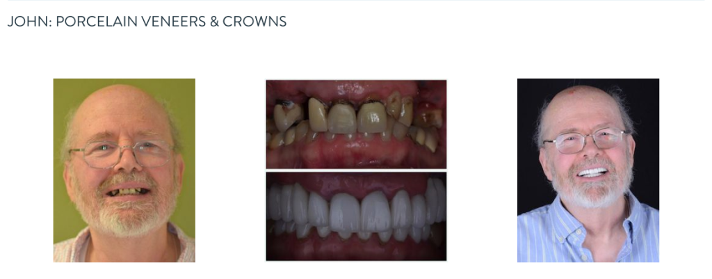 John Before After with porcelain veneers and crowns