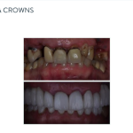 John Before After with porcelain veneers and crowns