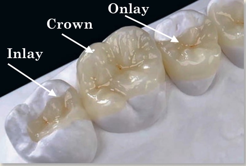 onlay, crown, and inlay on teeth