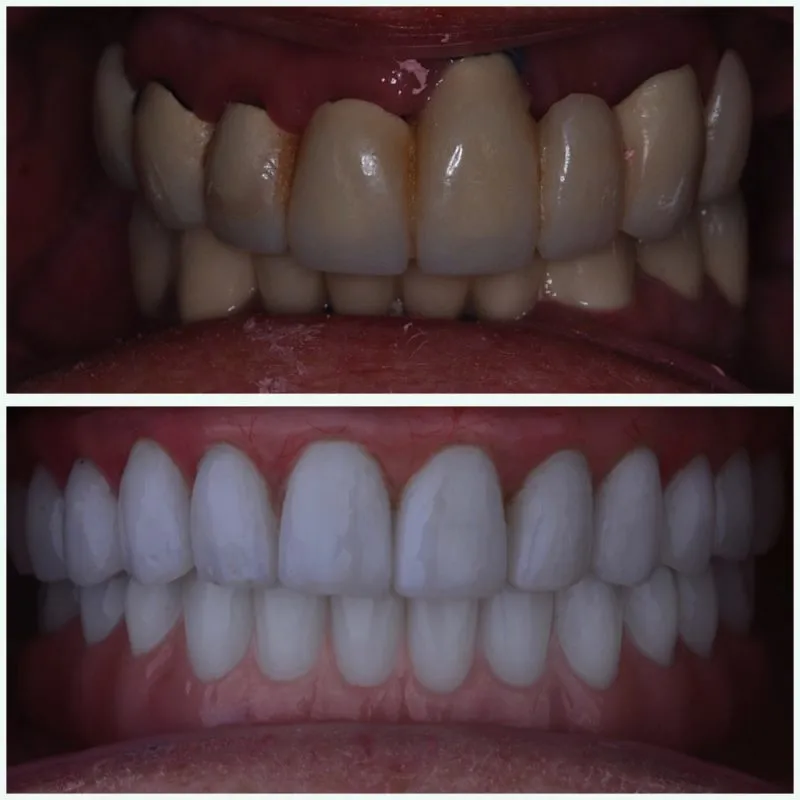 antes y después de All-ON-X: IMPLANTE FIJO HÍBRIDO