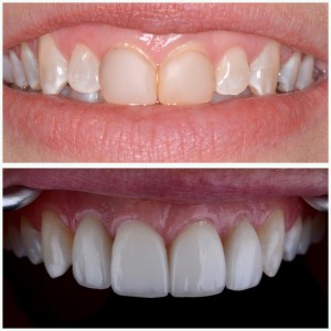 Before and after porcelain veneers