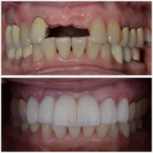 Woman Before and after Emax Porcelain Bridge