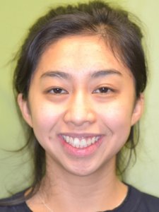 Woman before porcelain crowns