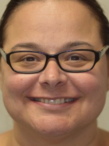 Woman Before Dental Implant and Porcelain Veneer
