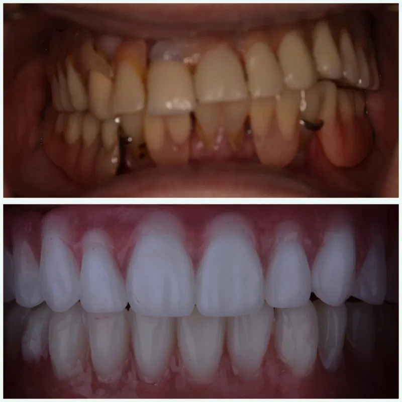 Antes y después de All On X- Dental Hybrid con soporte de implante de arco completo en Egg Harbor Township, Nueva Jersey, consultorio del dentista @serenitysmiledesigns
