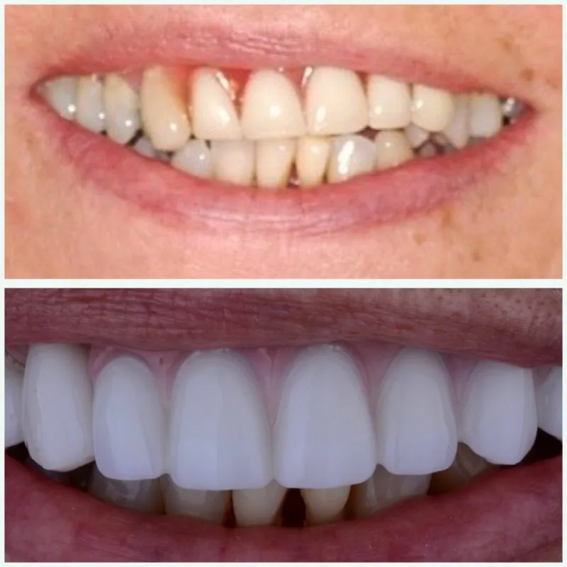 Antes y después de Implantes y Coronas Dentales