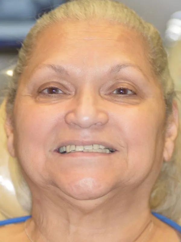Mujer ante todo en X- Híbrido dental soportado por implantes de arco completo