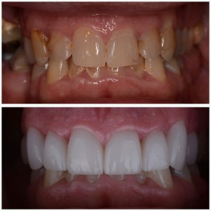 Before and after Porcelain Veneers