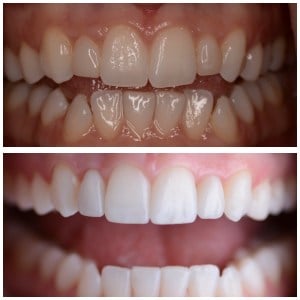 Before and after Upper Porcelain (2) Veneers and Invisalign