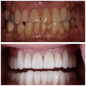 before and after close up of Charles' teeth