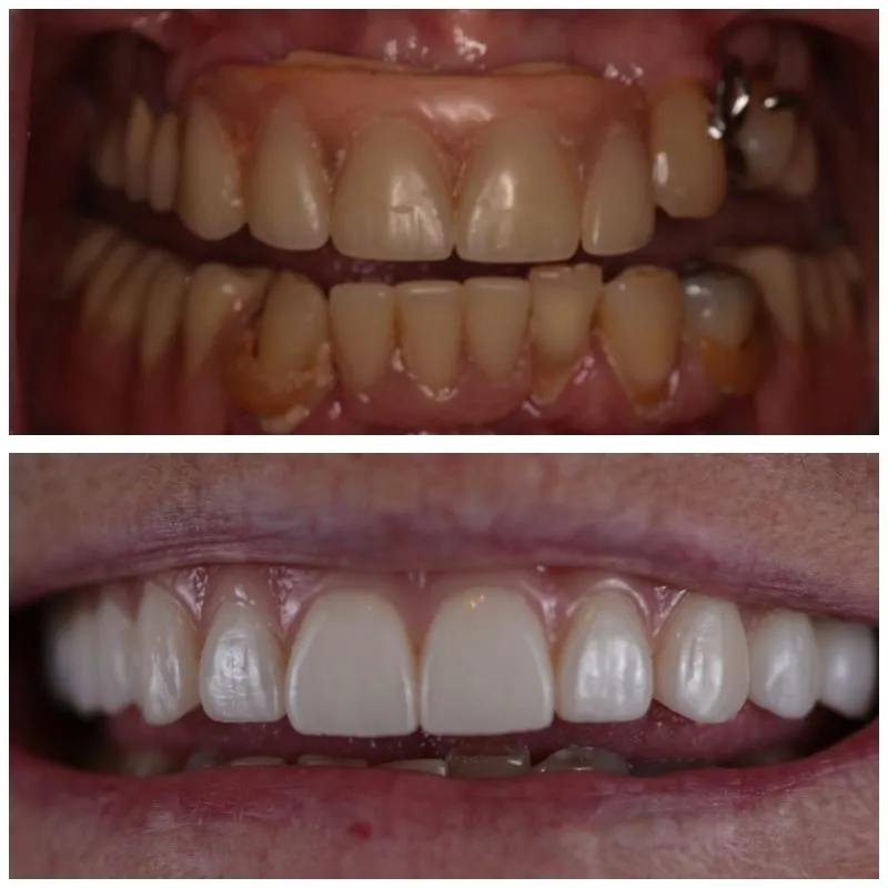 antes y después de Implantes Dentales y Carillas Superiores