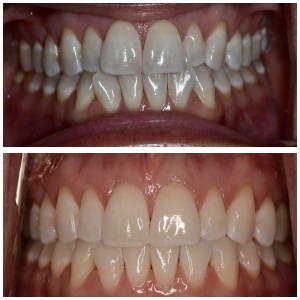 Before/After Invisalign