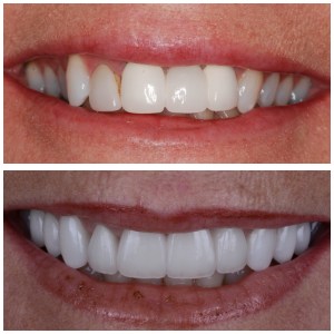 Before and after upper veneers and porcelain bridge