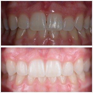 Galería de sonrisa antes y después de la foto