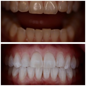 Galería de sonrisa antes y después de la foto
