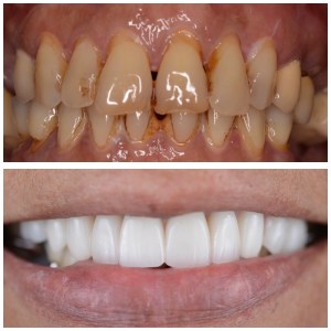 before and after close up of Lori's teeth