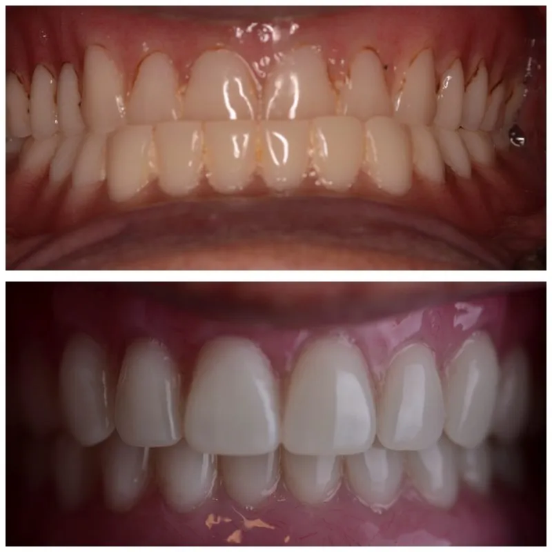Egg Harbor Twp, Nueva Jersey, dentaduras postizas sobre implantes