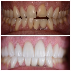 before and after close up of Rob's teeth