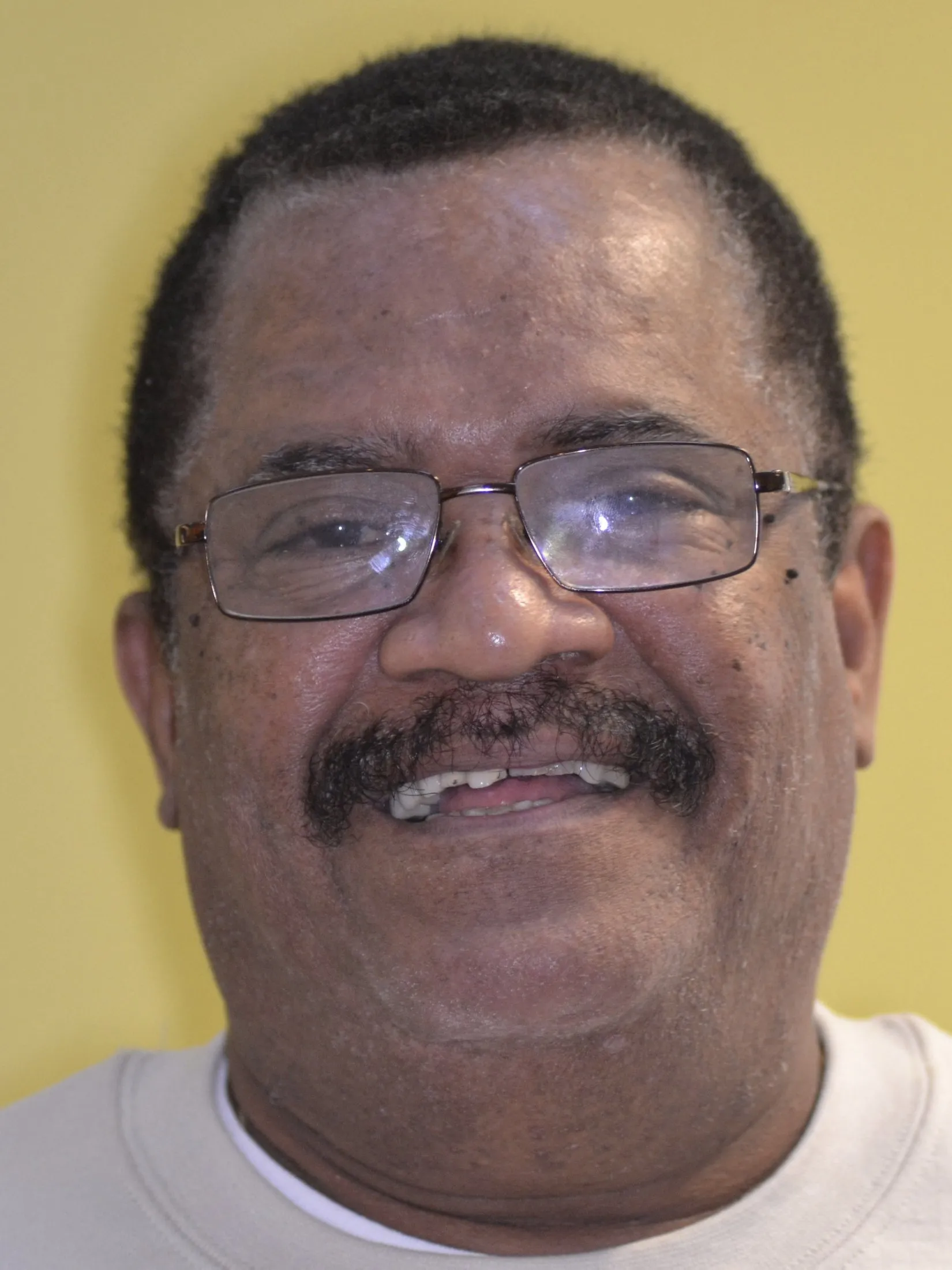 Ron - Upper implant hybrid, Invisalign and veneers before picture