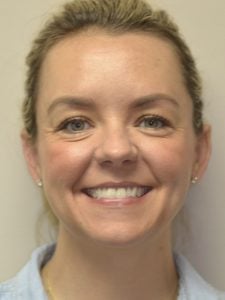 woman before Invisalign