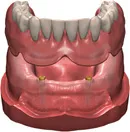 Implant Retained Snap on Denture
