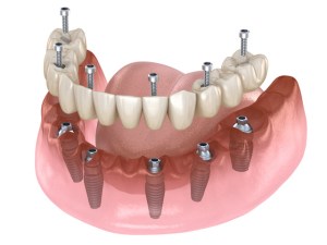 Implant Supported Hybrid Denture