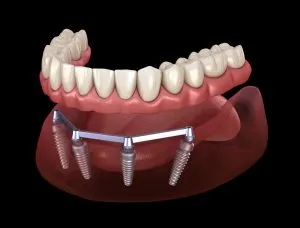 Implant Supported Bar Overdentures