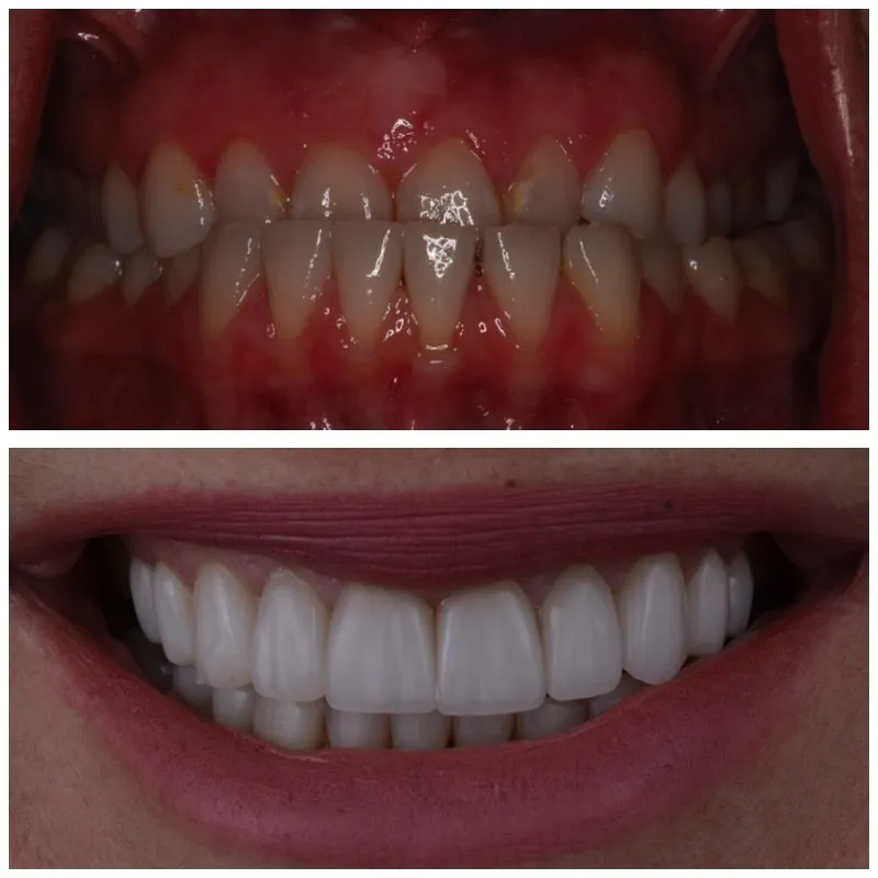 galería de sonrisas - antes y después