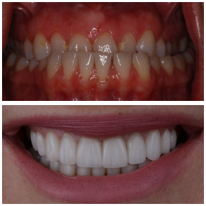smile gallery - before and after