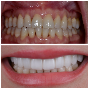 Before and after full mouth rehabilitation