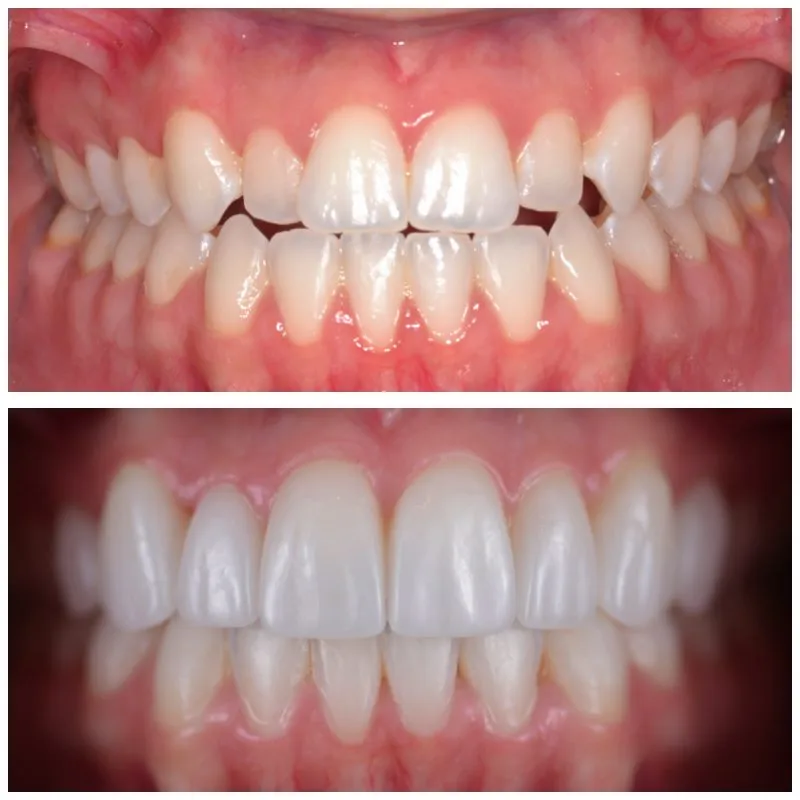 galería de sonrisas - antes y después